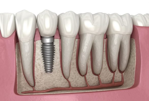 تیتانیوم در صنعت دندانپزشکی